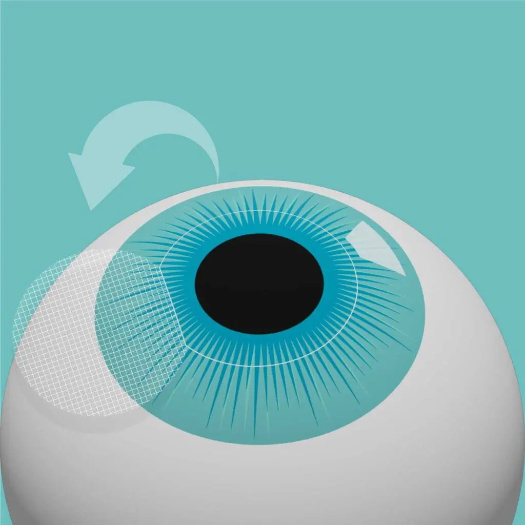 Laser-eye-surgery-procedure-step-3.