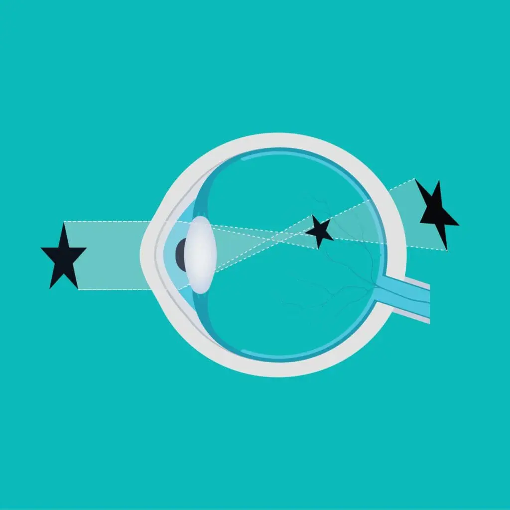 why-i-need-glasses-Astigmatism graphic