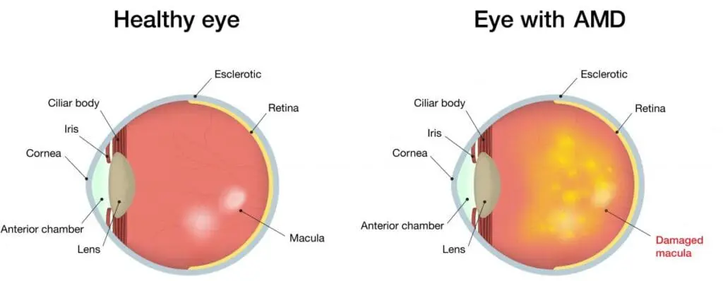 Diagram showing a healthy eye versus and eye with age-related macular degeneration (ARMD)