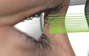 DSLT/SLT - Glaucoma Laser Therapy