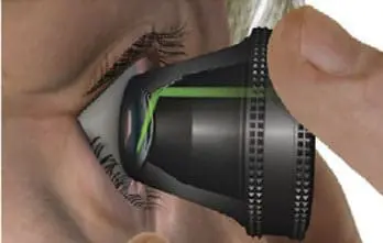 DSLT/SLT - Glaucoma Laser Therapy