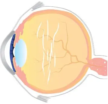 Vitreolysis Laser Treatment of Floaters