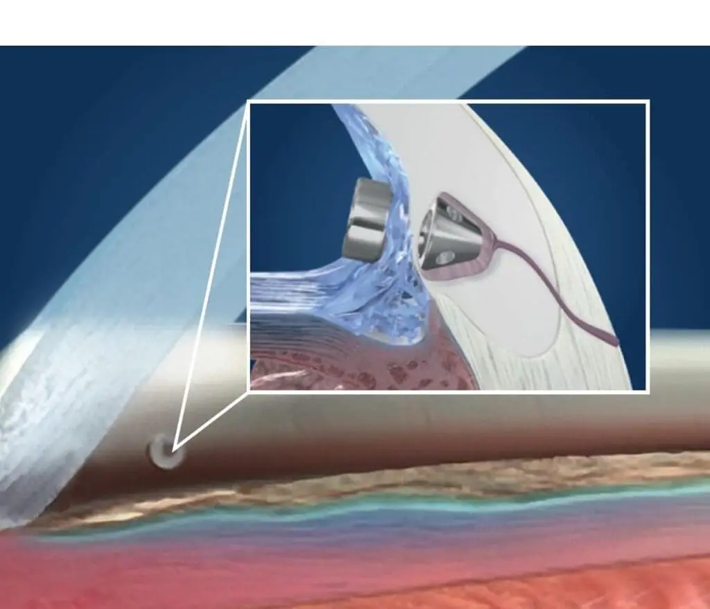 Stent-procedure-eye-2