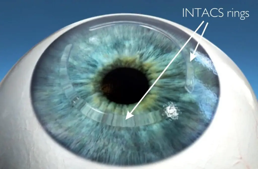 Intacs-rings-centre-for-sight.