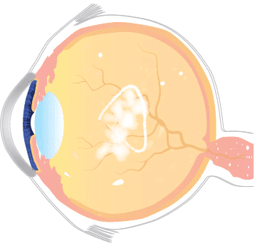 Centre for Sight Flashes and Floaters diagram