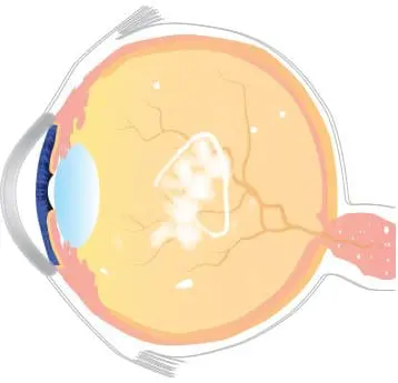 Vitreolysis Laser Treatment of Floaters