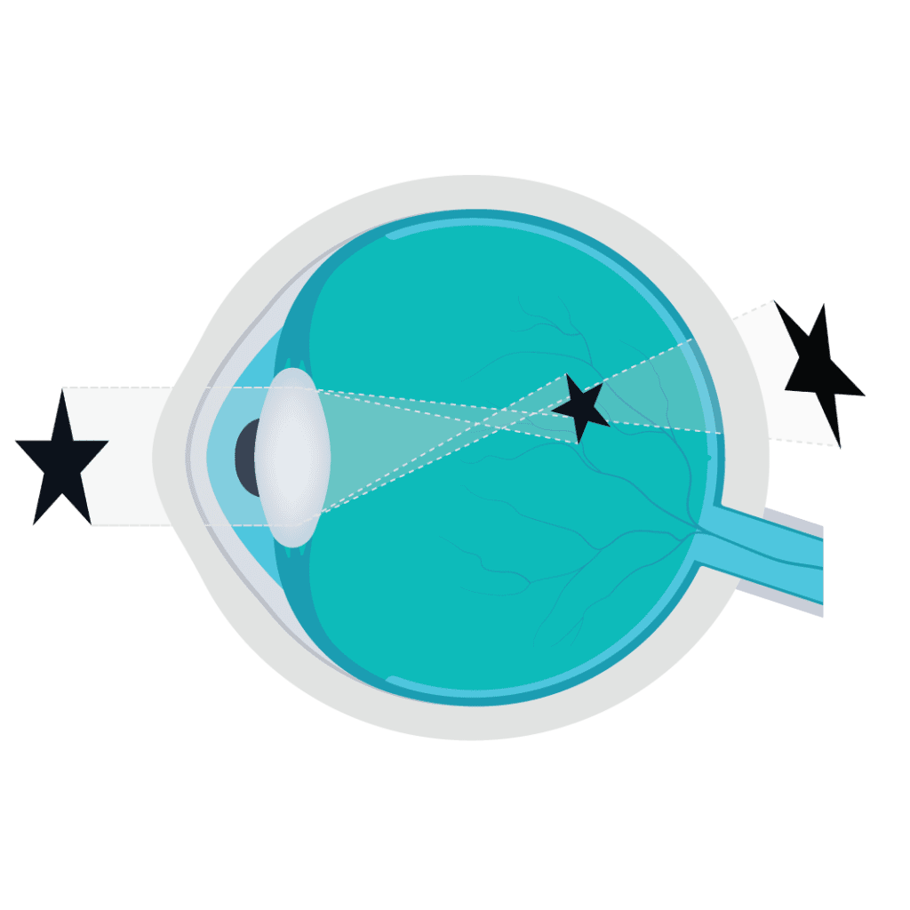 diagram on the eye to show astigmatism, one of four common eyesight problems
