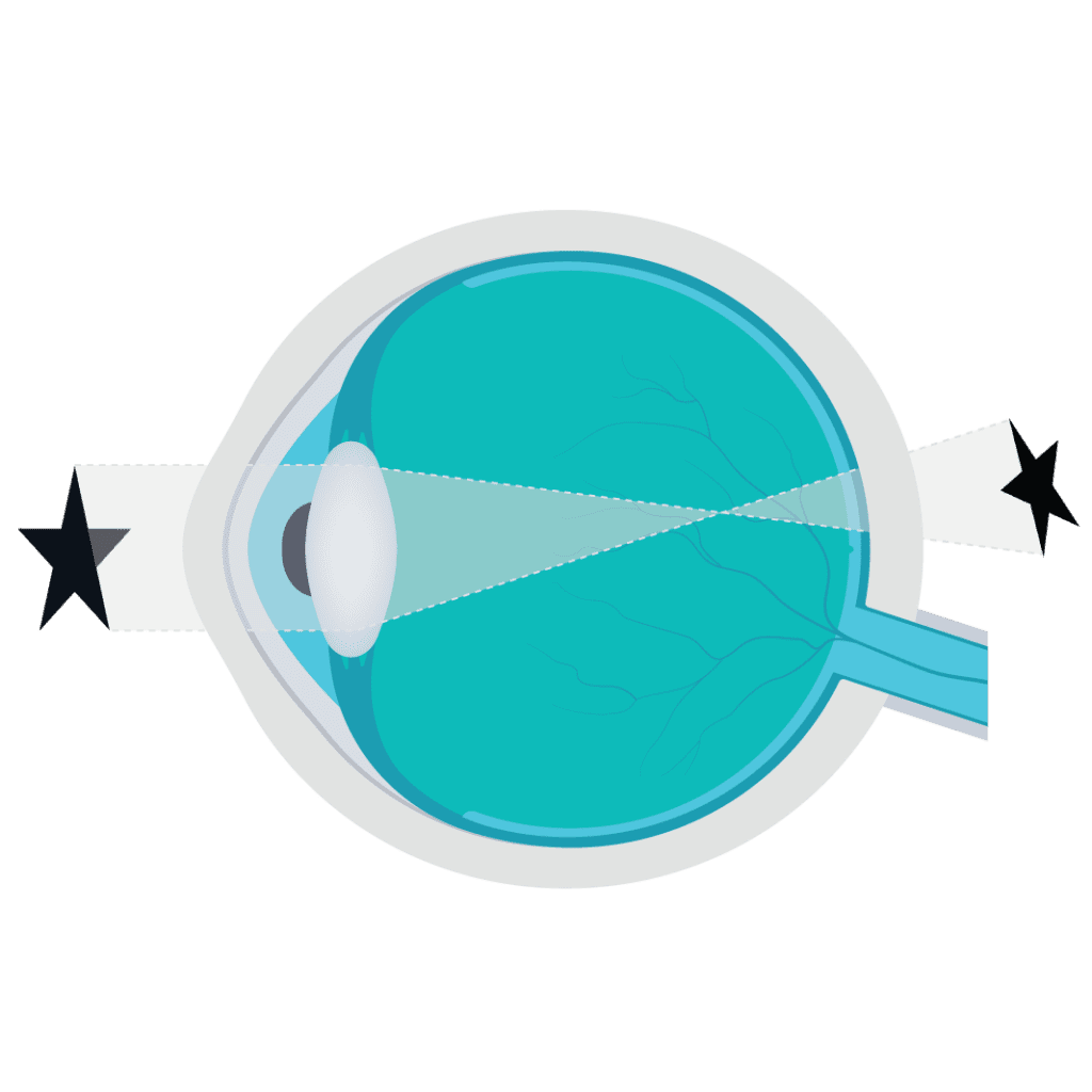 diagram on the eye to show farsightedness, one of four common eye conditions