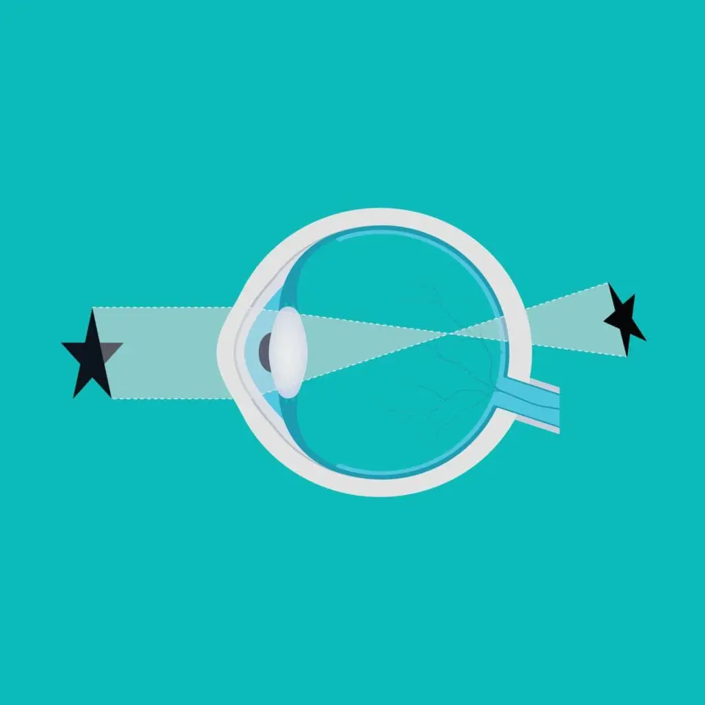 Hyperopia graphic