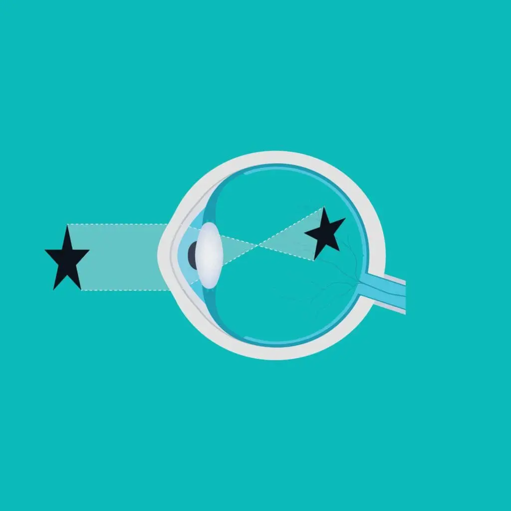 Myopia graphic
