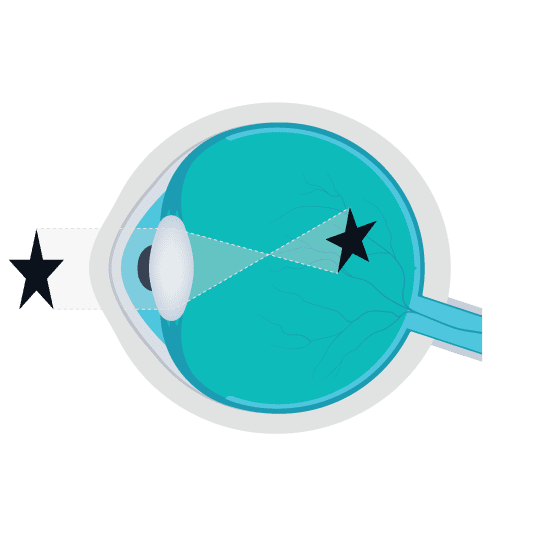 diagram on the eye to show shortsightedness, one of the four common eyesight problems