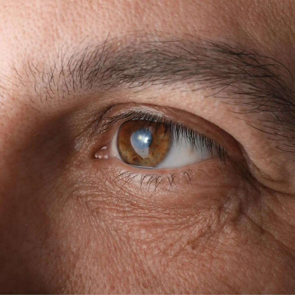 Older man with grey eyebrows and cataract close up of eye for VICTUS laser cataract latest news