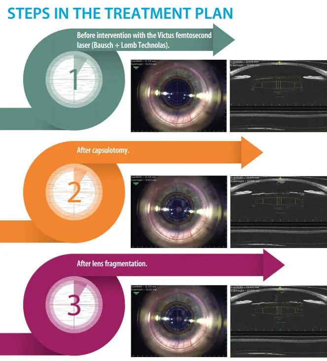 Eye Surgeon: Why I had Laser Cataract Surgery at Centre for Sight