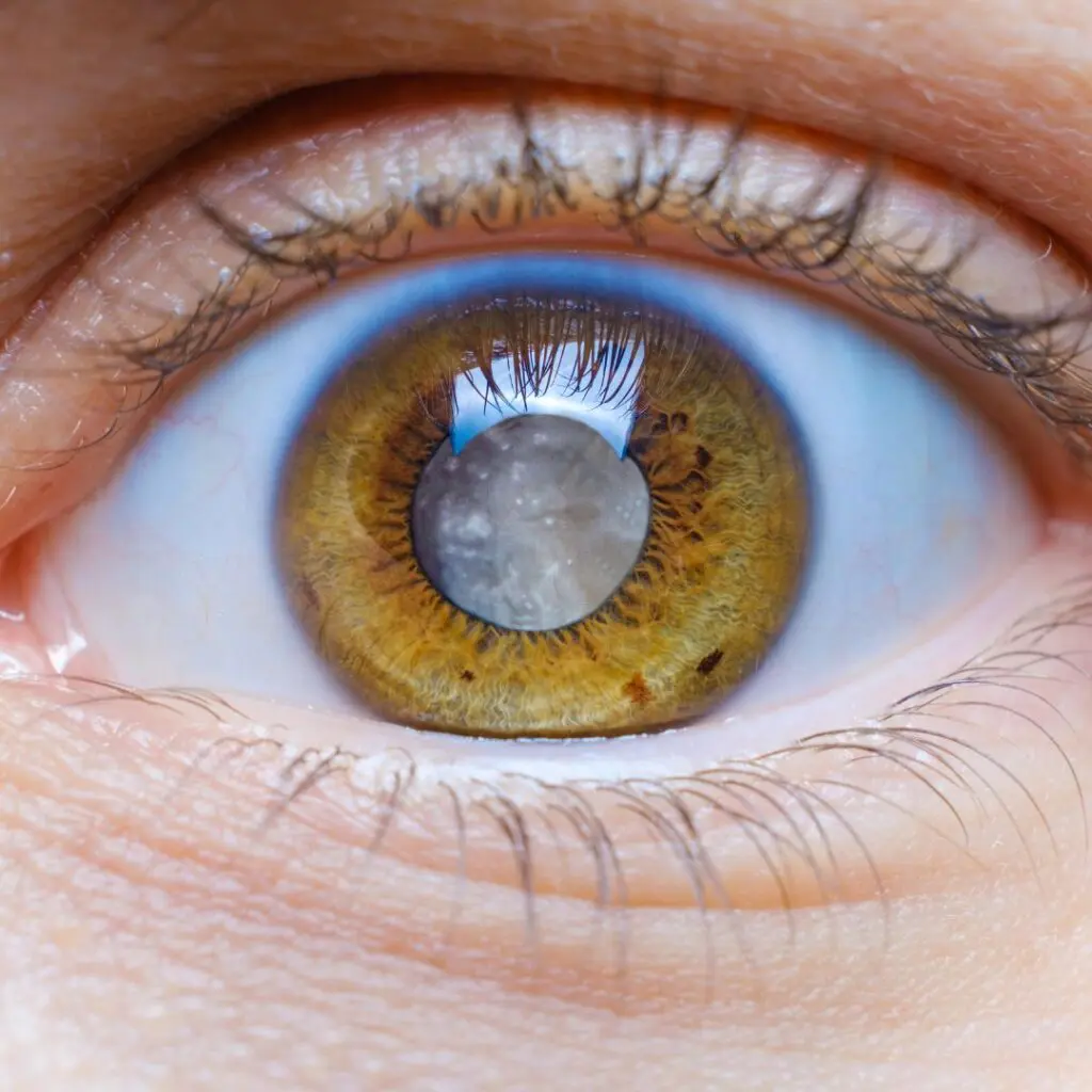 Centre for Sight cataract in eye prior to cataract surgery treatment