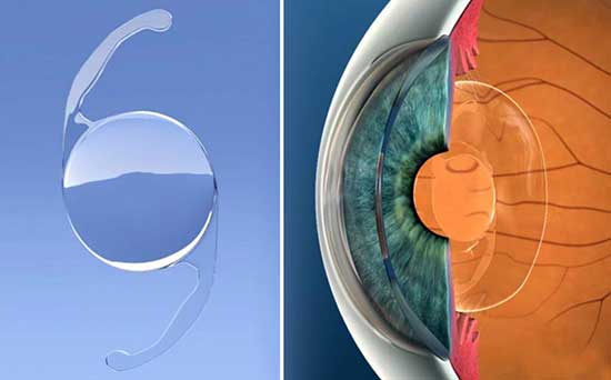 Monofocal Lenses for Cataract and Lens Replacement Surgery