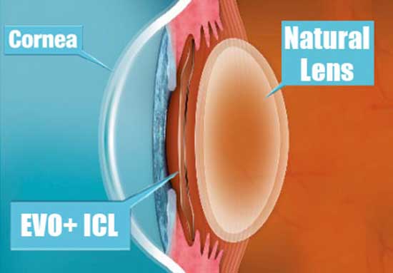 EVO Visian ICL implanted cross section position 2