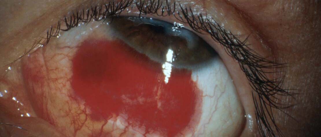 Subconjunctival bleed eye – redness of the eye