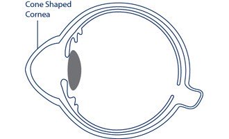 Keratoconus Eye Illustration