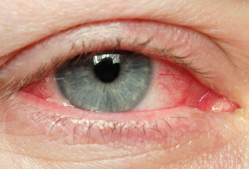 Redness of the eye