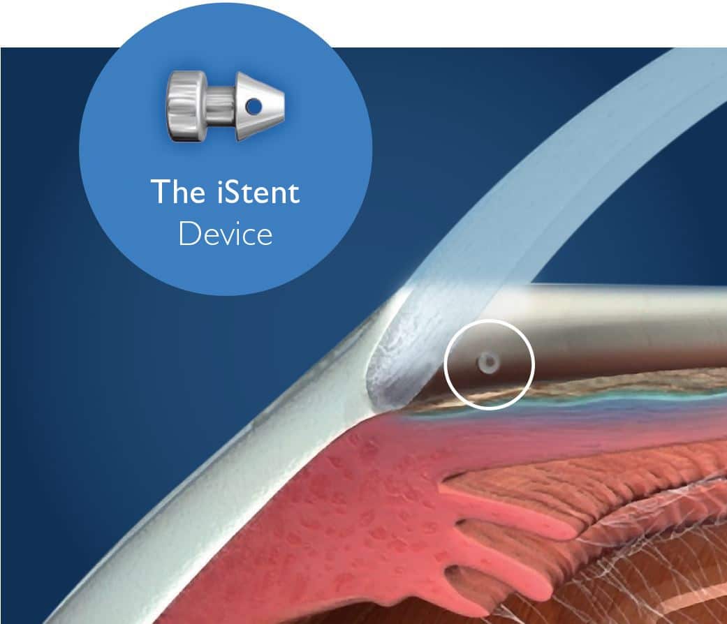 iStent for Glaucoma treatment MIGS
