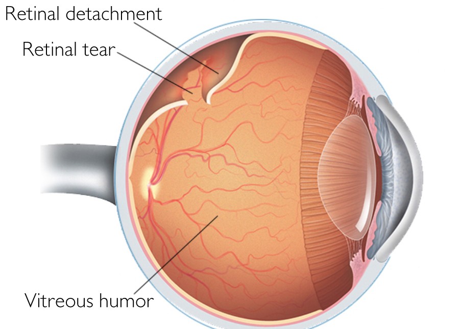 Retina and Vitreous Treatment at Centre for Sight