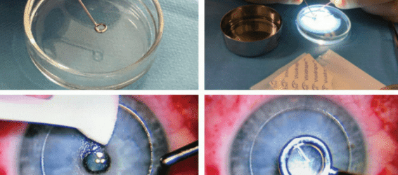 Allotex Inlay implanted first in UK by Sheraz Daya