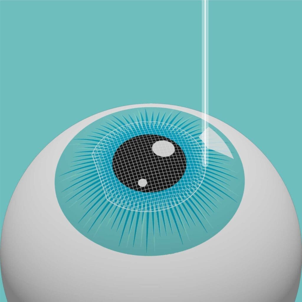 Laser-eye-surgery-procedure-step-2