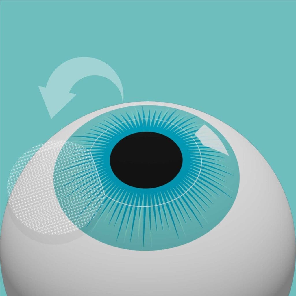 Laser-eye-surgery-procedure-step-3.