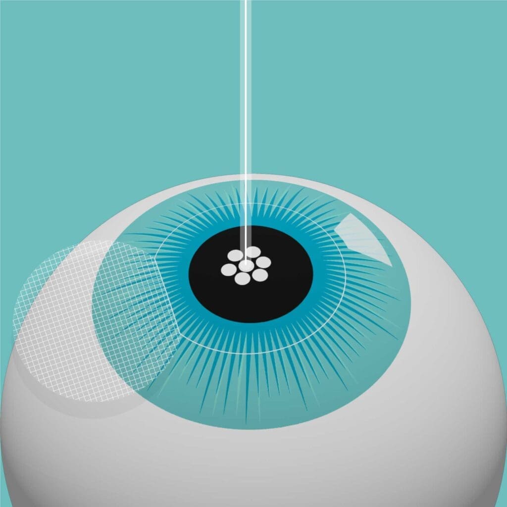 Laser-eye-surgery-procedure-step-fina