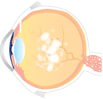 Centre for Sight Flashes and Floaters diagram - diffuse