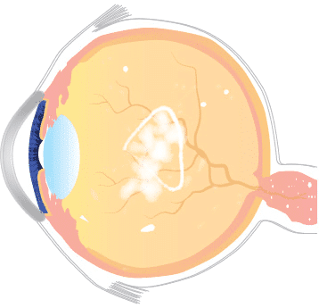Centre for Sight Flashes and Floaters diagram
