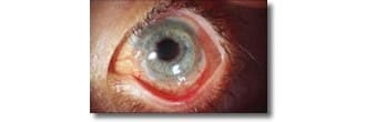 Centre for Sight Post Op Stem Cell