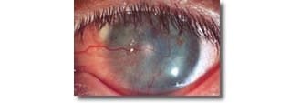 Centre for Sight Pre Op Stem Cell