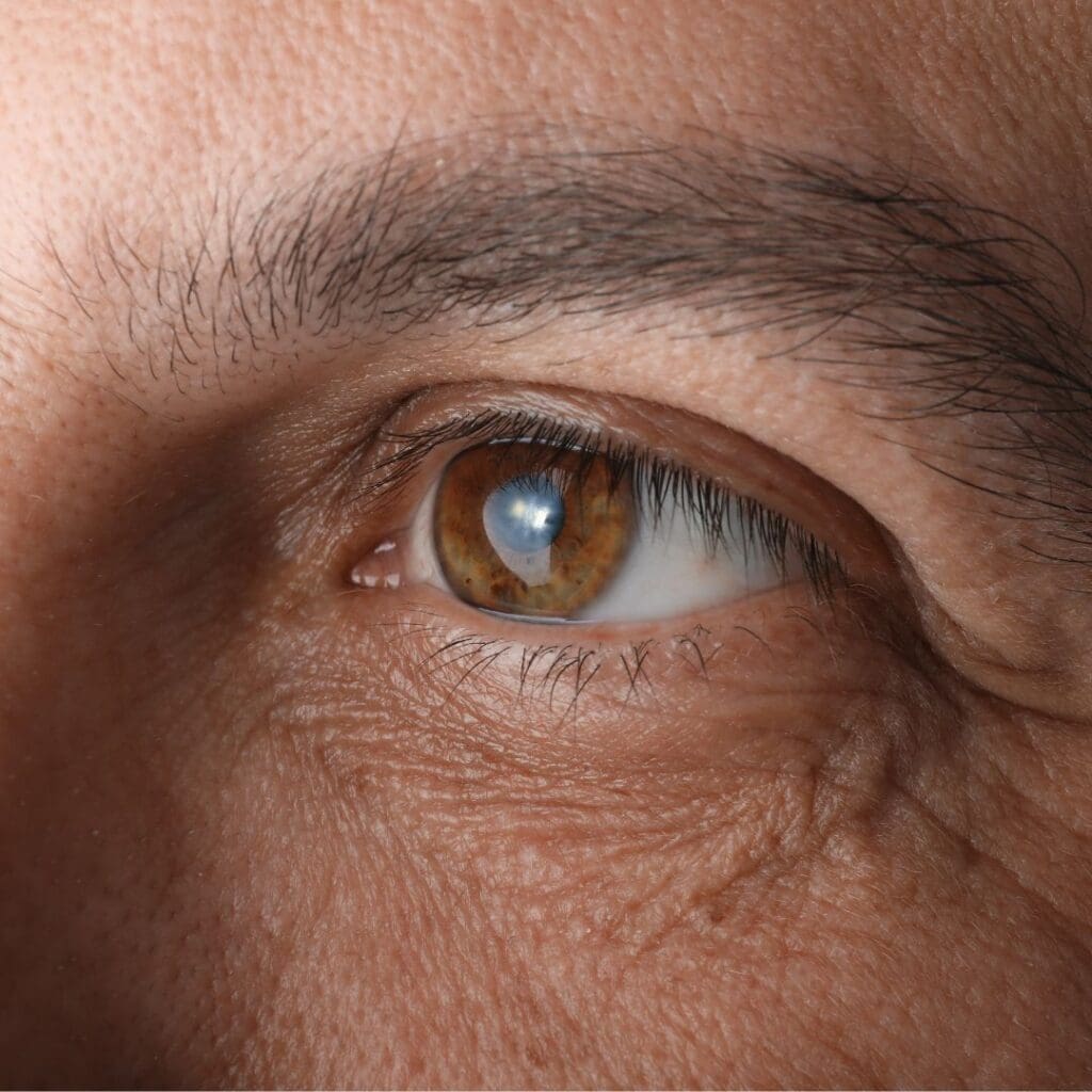 Older man with grey eyebrows and cataract close up of eye for VICTUS laser cataract latest news