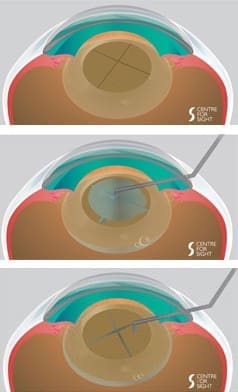 Centre for Sight eye-vic-column graphic