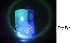 Centre for Sight - Stained Cornea