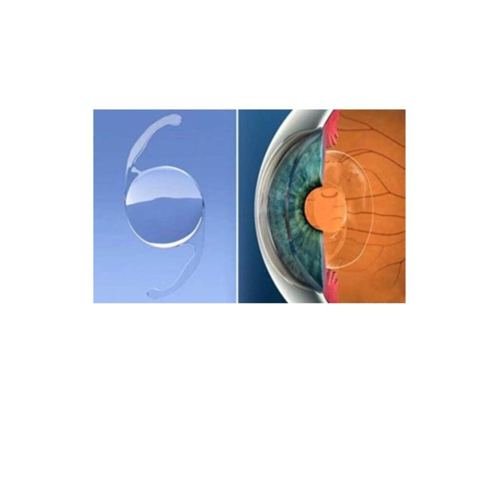 Centre for Sight Monofocal Lens stock image for blog post what are the different types of lenses used for cataract and laser lens replacement surgery