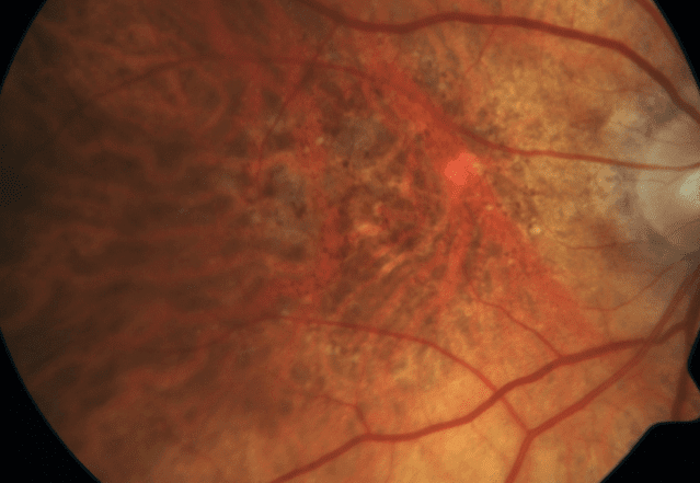 Macular Degeneration (ARMD) 3 Close-up image of a human retina showing prominent blood vessels, a pale optic disc on the right, and a yellowish area with a bright spot, suggesting possible retinal abnormality or damage such as ARMD (Age-Related Macular Degeneration).