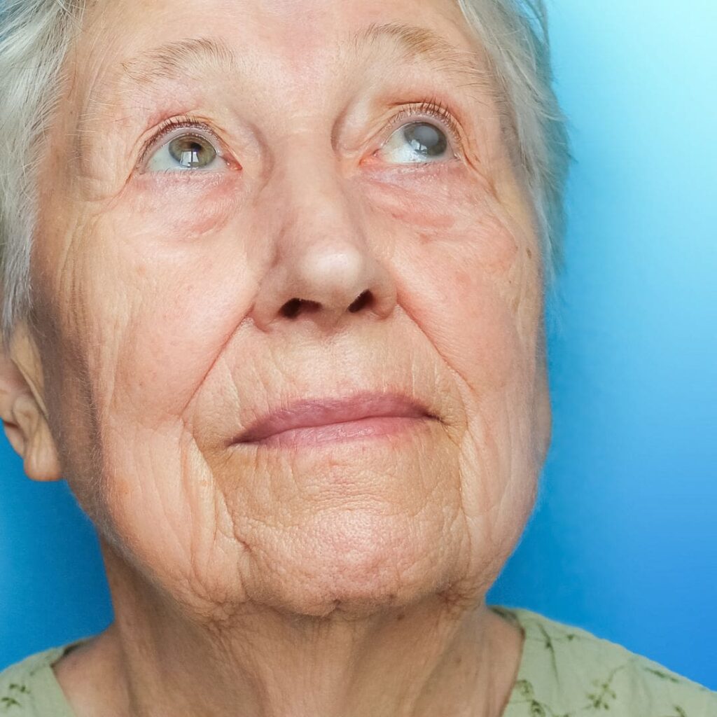 Centre for Sight Cataract Awareness Month lady with cataract in eye